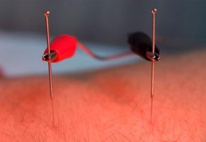 Acupunctura si electronica