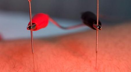 Acupunctura si electronica